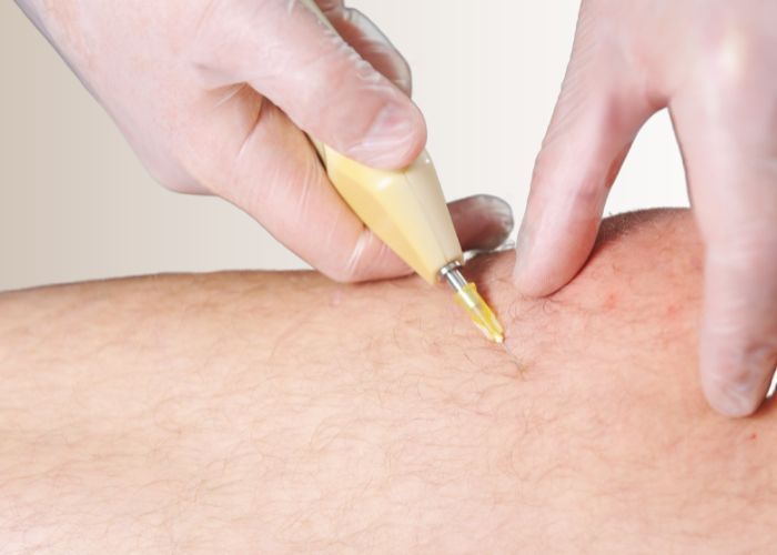 carboxiterapia (2)